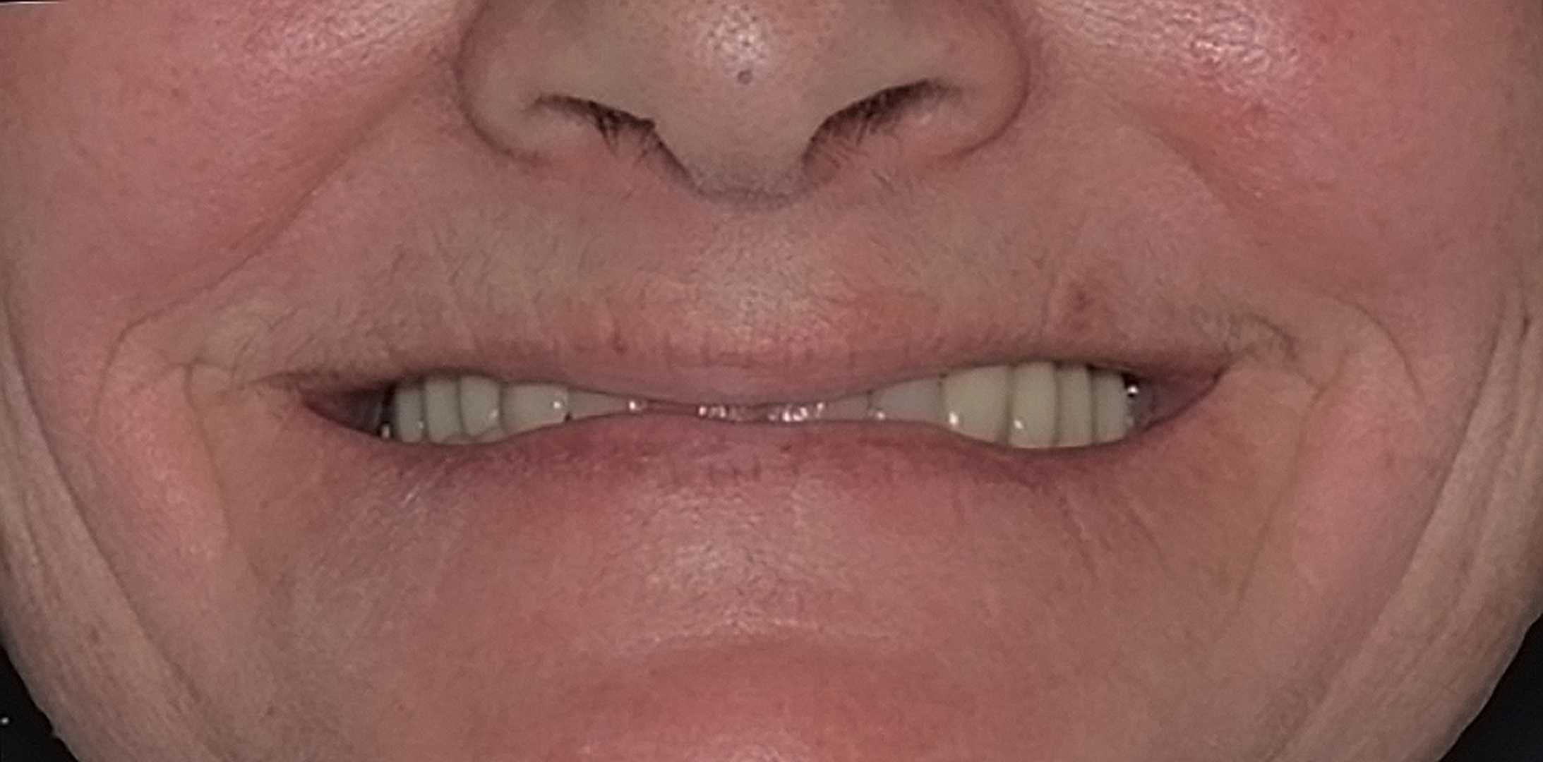 Fig. 24: Individualised, digitally produced complete maxillary and mandibular dentures in situ, en face view, habitual bite (CediTEC).