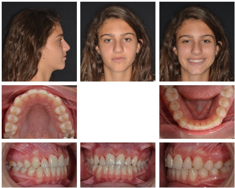 Figs. 11a–h: Pre-aligner treatment facial and intra-oral photographs.