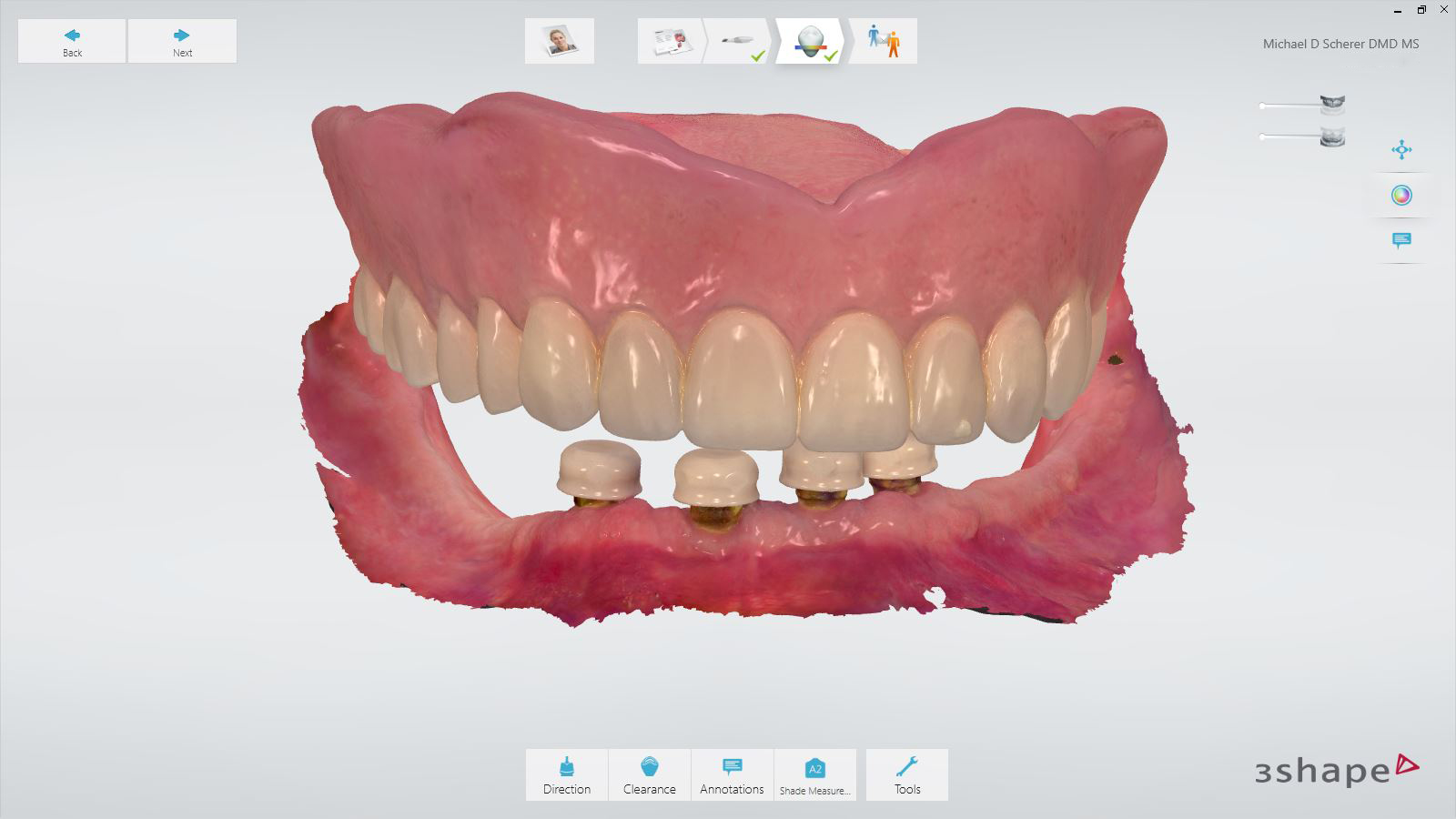 Scan of the maxillary prosthesis and the opposing arch.