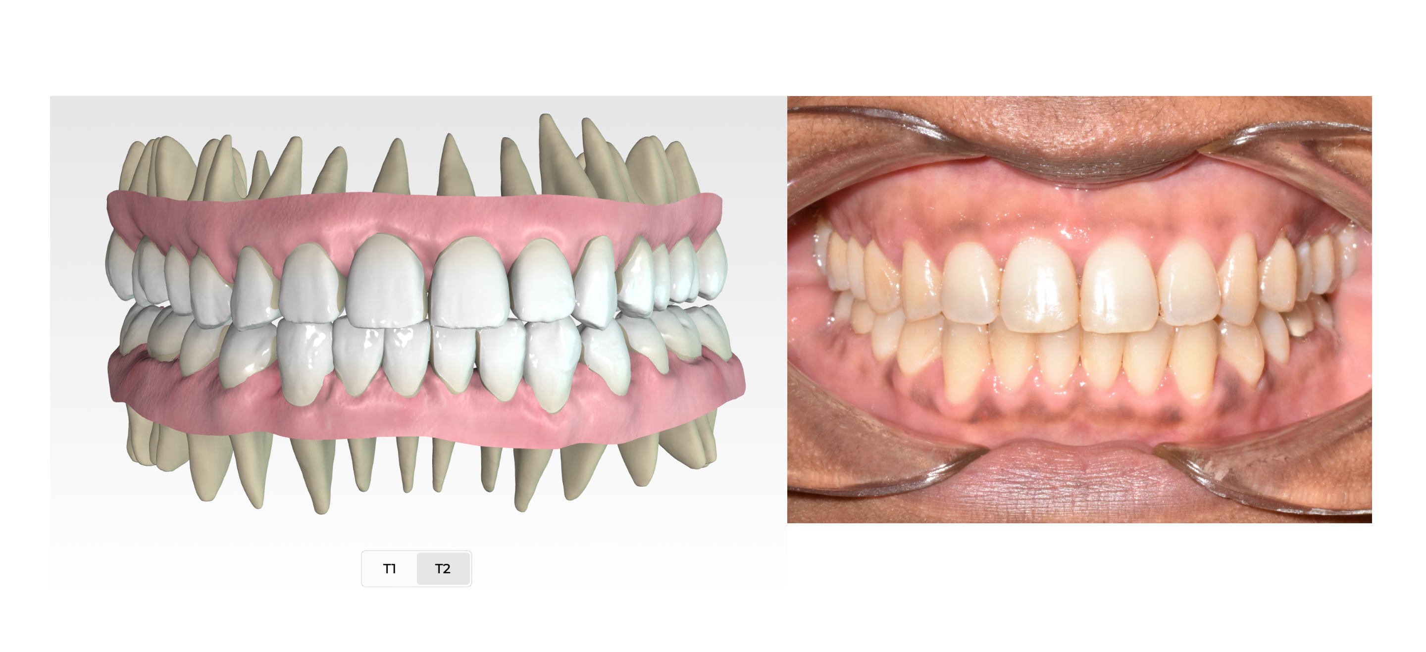 Dental News - Non-invasive correction of Class III anterior open